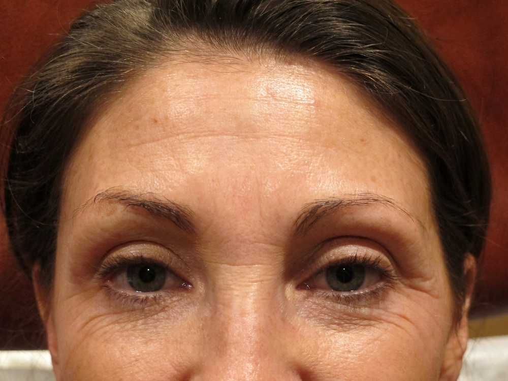 botox Before Photo for Patient #1