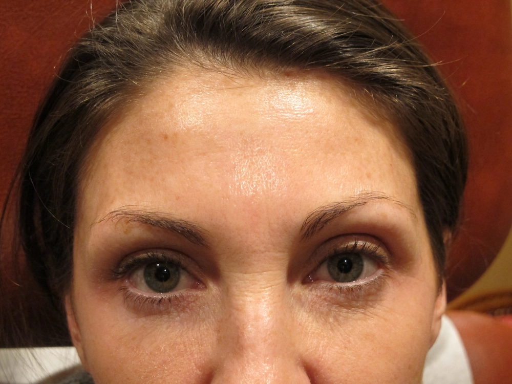 botox After Photo for Patient #1