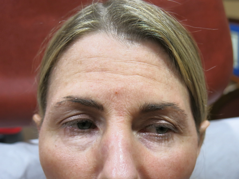 botox Before Photo for Patient #2