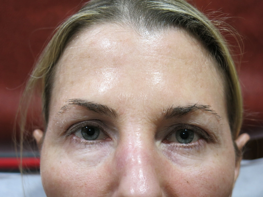 botox After Photo for Patient #2