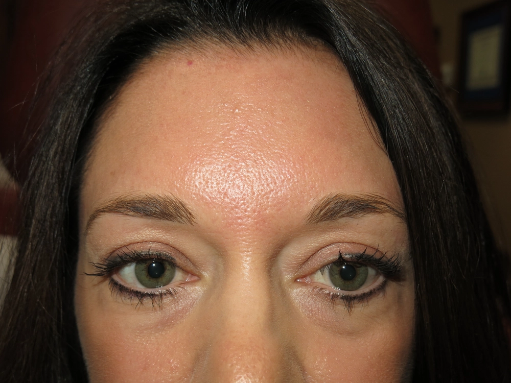 botox After Photo for Patient #3