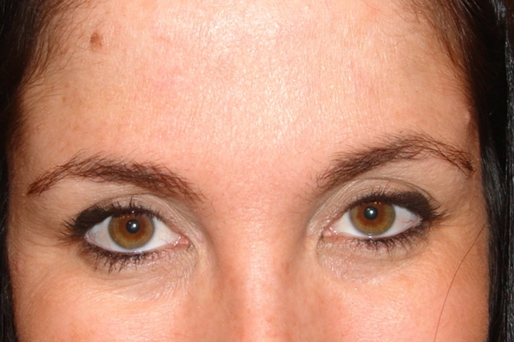 botox After Photo for Patient #5