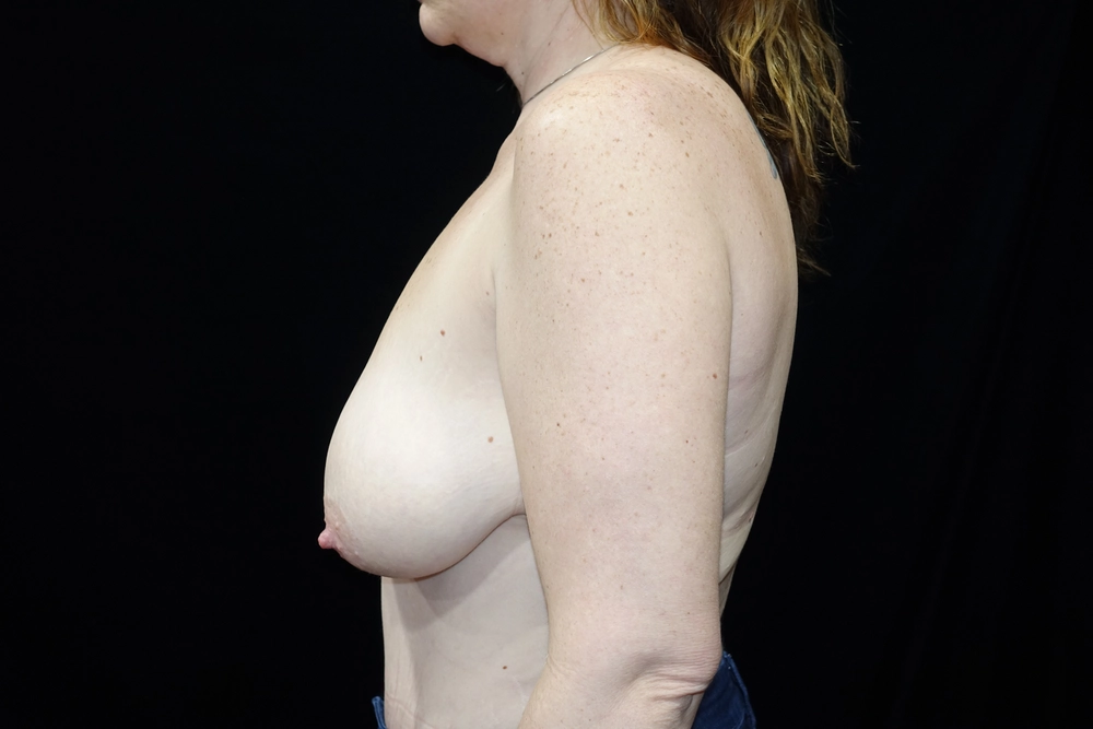 breast-lift Before Photo for Patient #2