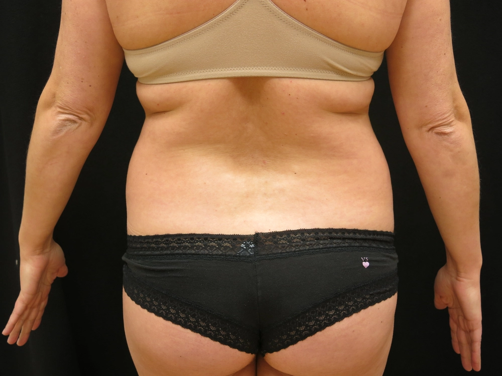 fat-transfer Before Photo for Patient #8