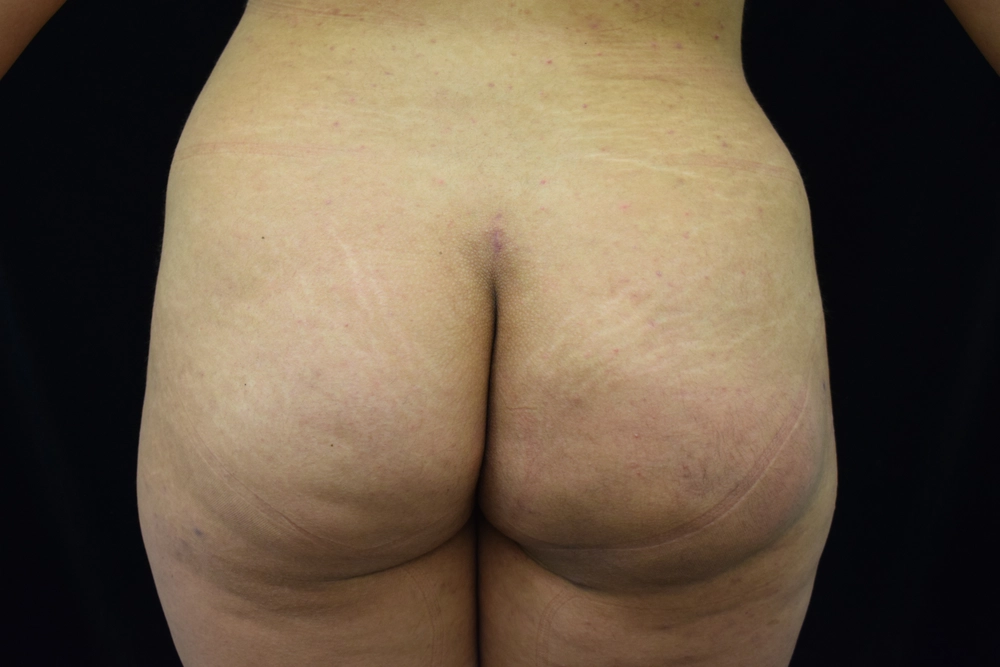 fat-transfer After Photo for Patient #10