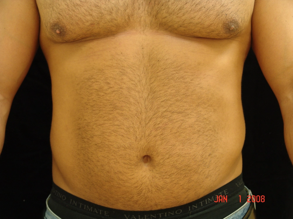 liposuction Before Photo for Patient #1