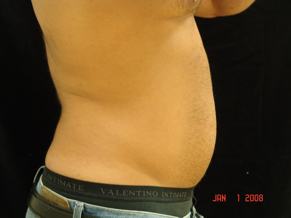 liposuction Before Photo for Patient #1
