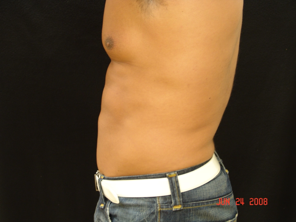 liposuction After Photo for Patient #1