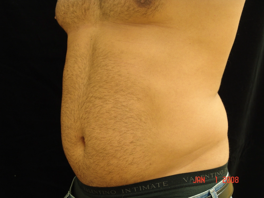 liposuction Before Photo for Patient #1