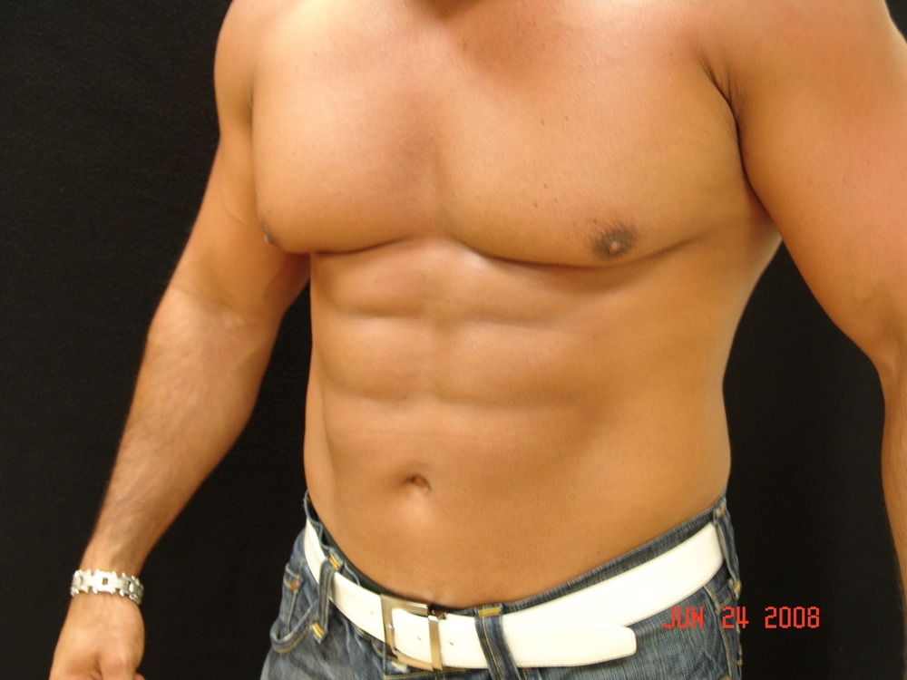 liposuction After Photo for Patient #1