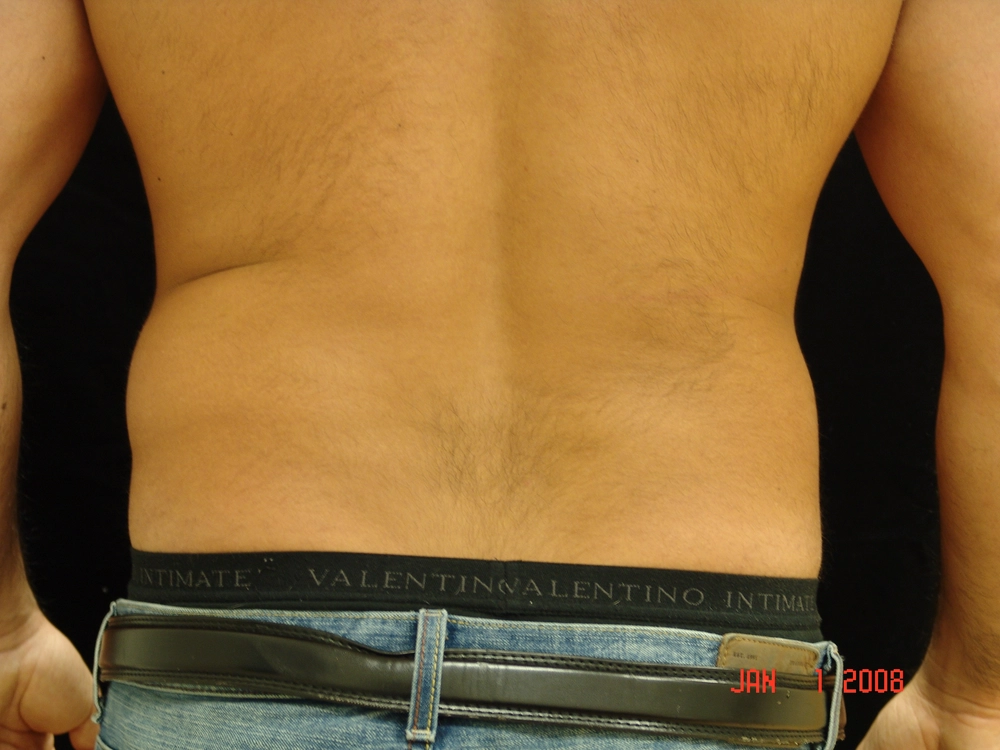 liposuction Before Photo for Patient #1