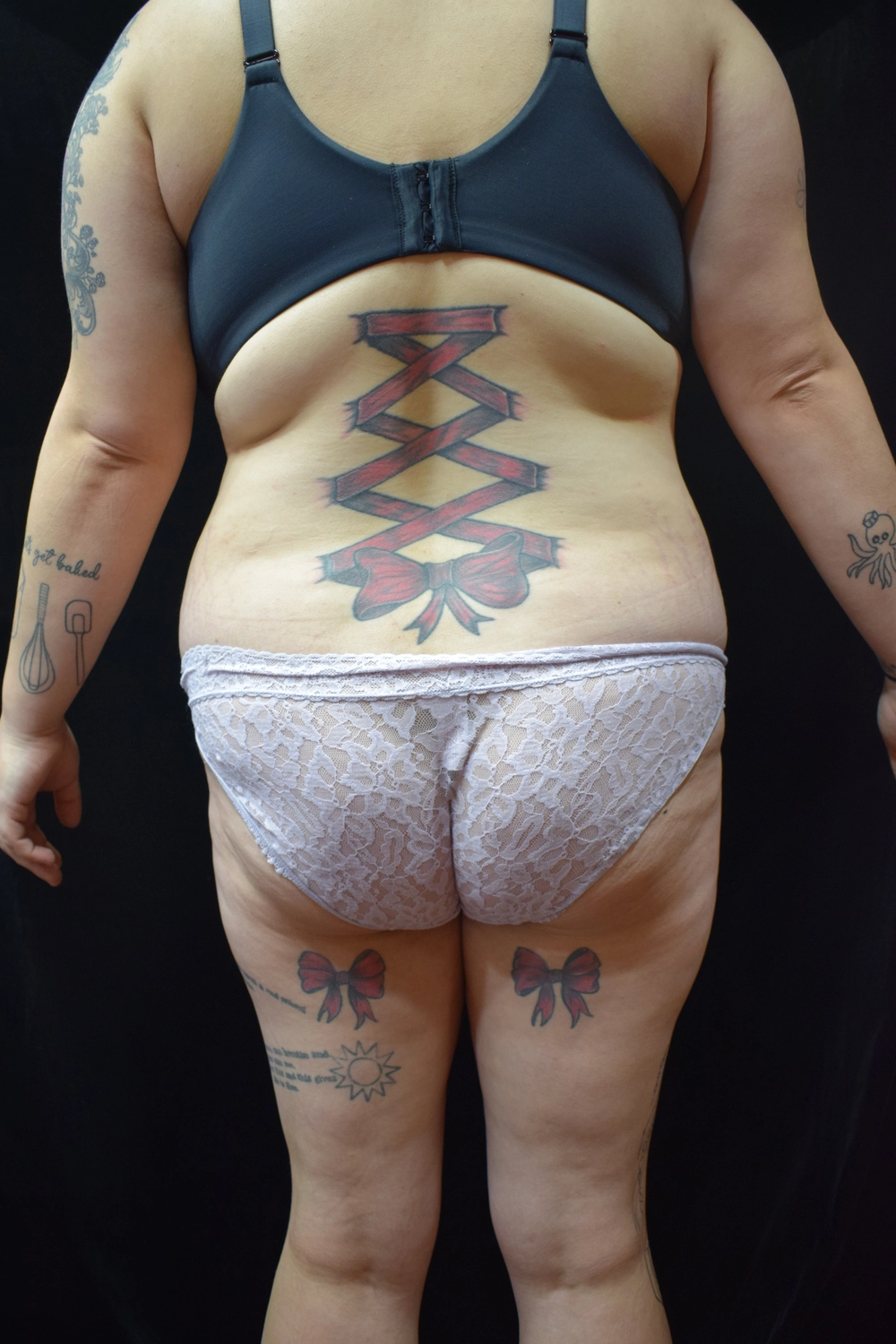 liposuction Before Photo for Patient #11