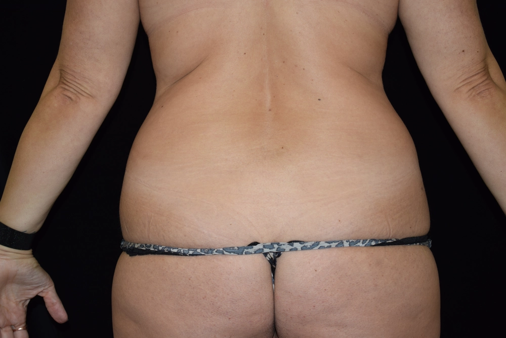 liposuction Before Photo for Patient #12