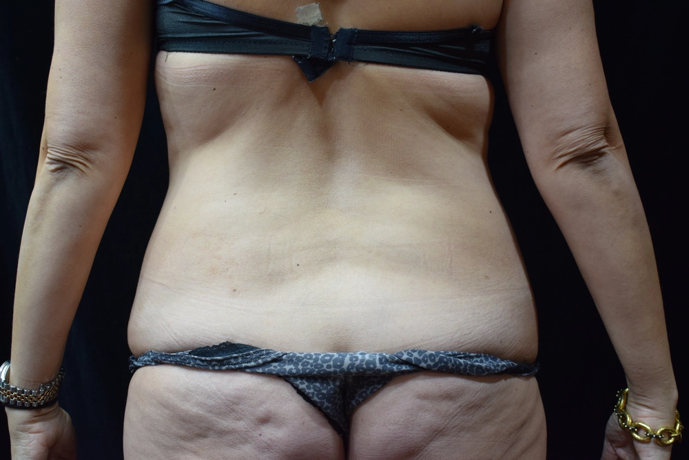 liposuction Before Photo for Patient #13