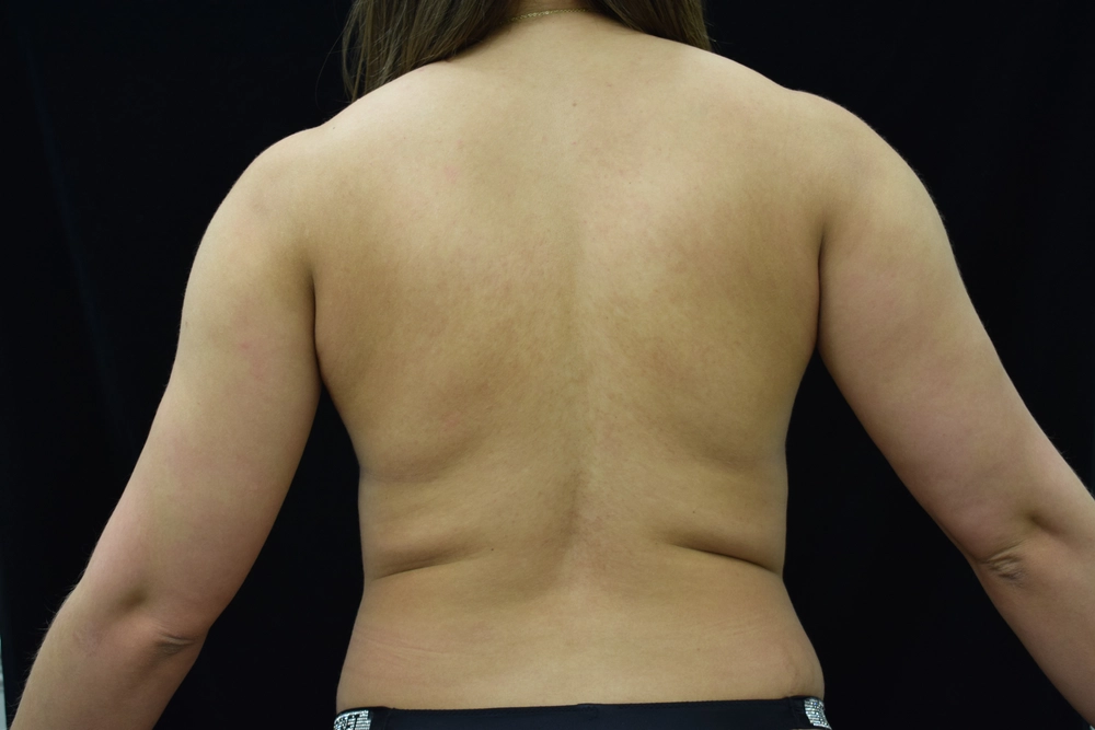 liposuction Before Photo for Patient #15