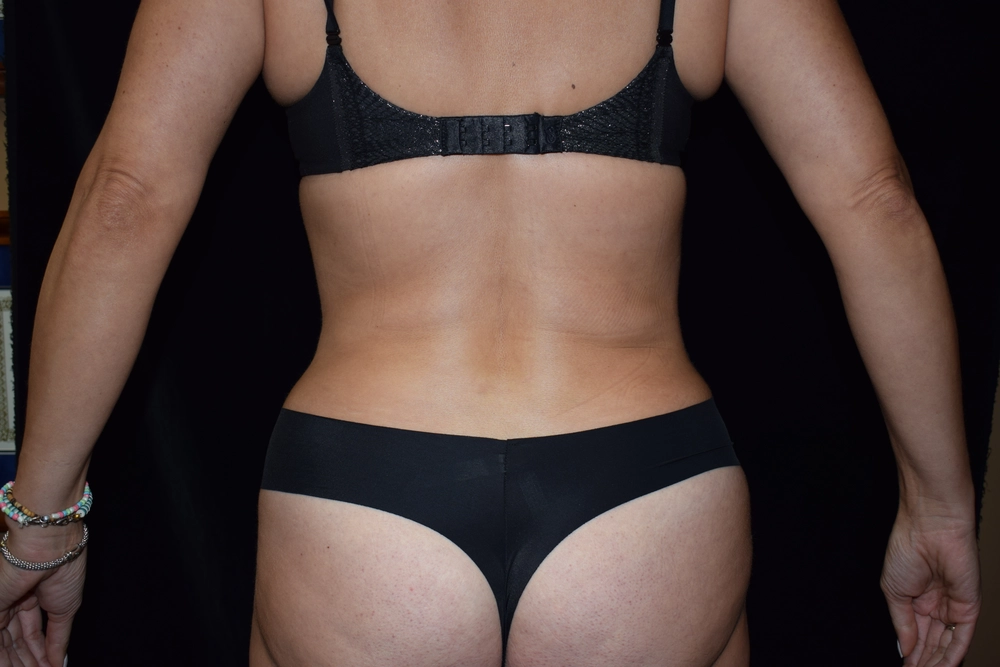 liposuction After Photo for Patient #18