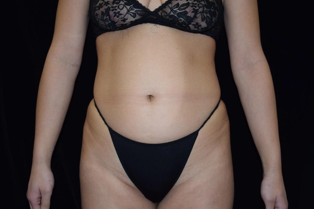 liposuction Before Photo for Patient #2