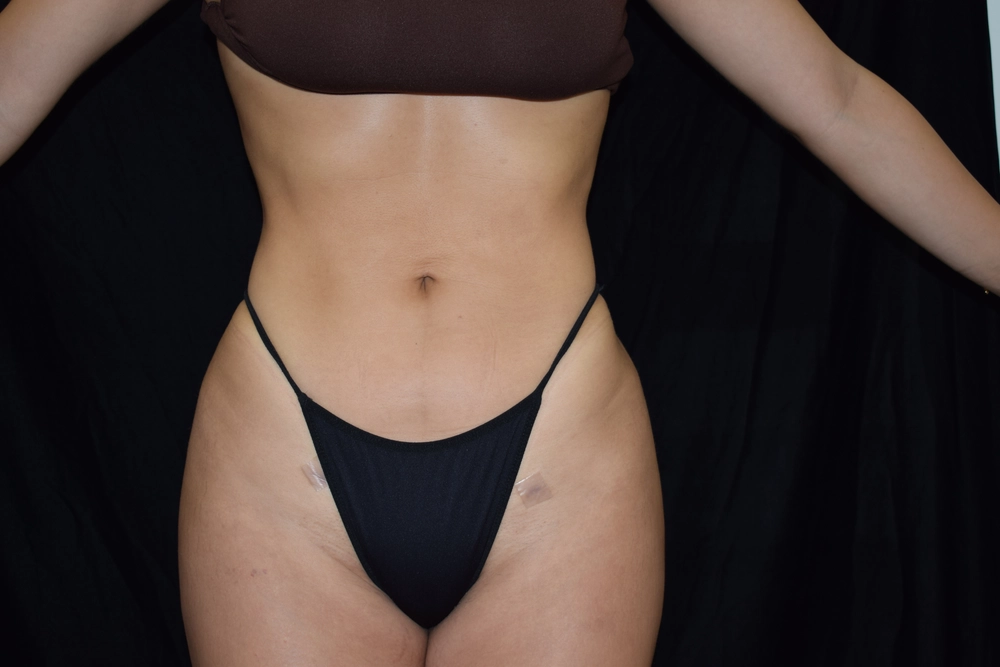 liposuction After Photo for Patient #2