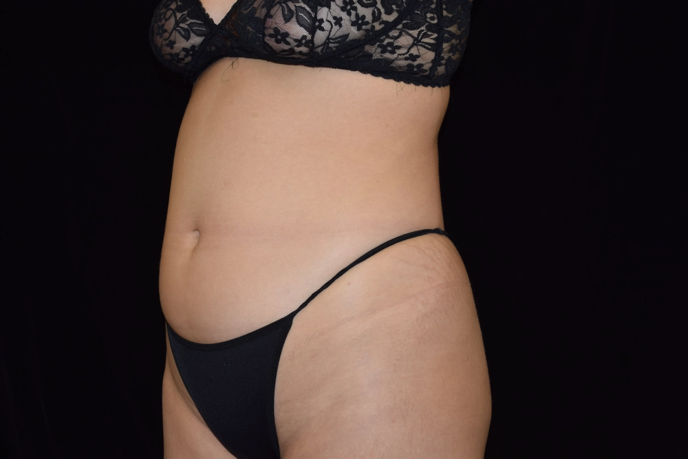 liposuction Before Photo for Patient #2