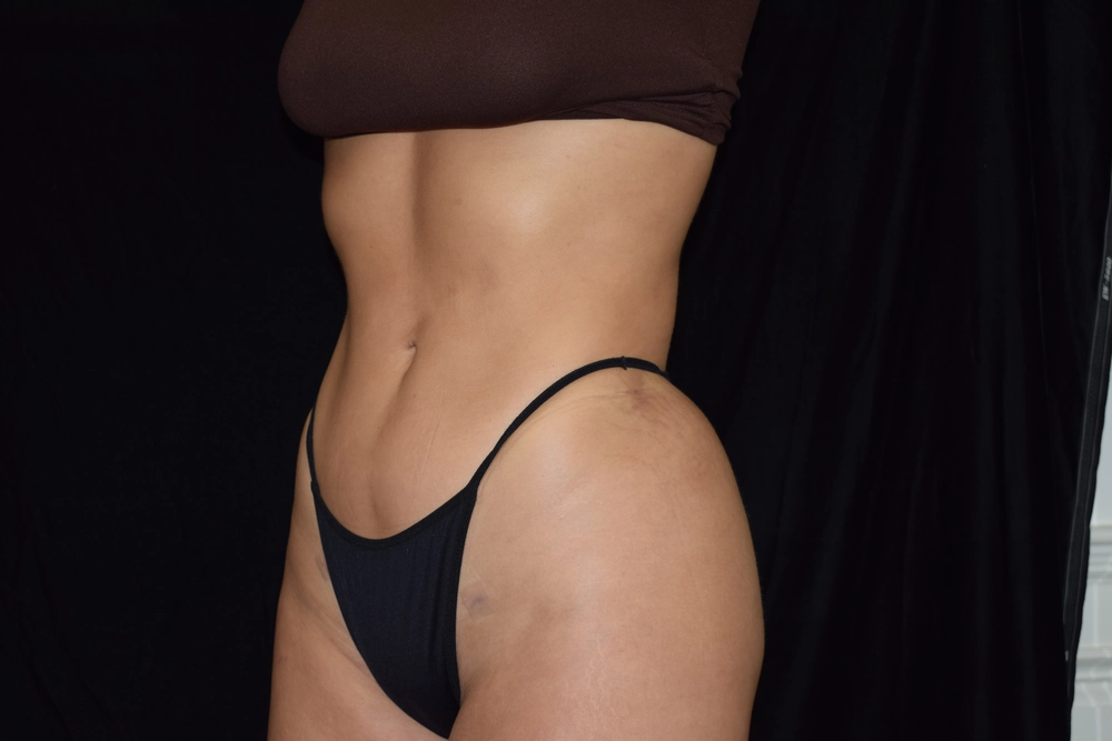 liposuction After Photo for Patient #2