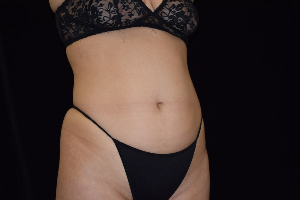 liposuction Before Photo for Patient #2