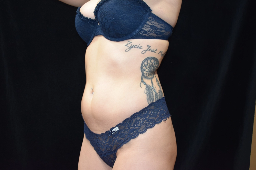 liposuction Before Photo for Patient #3