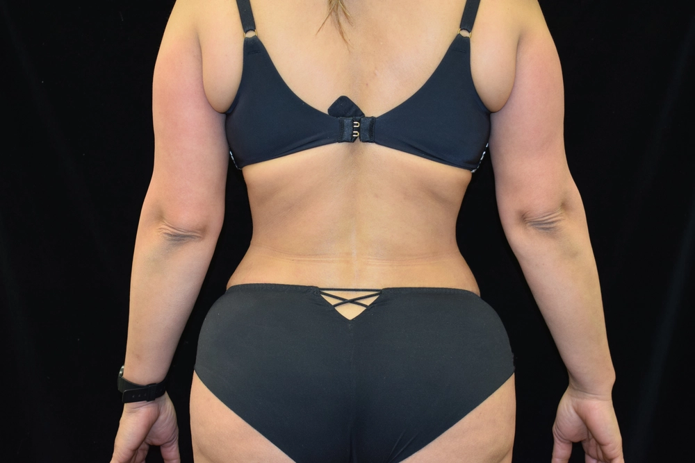 liposuction After Photo for Patient #4