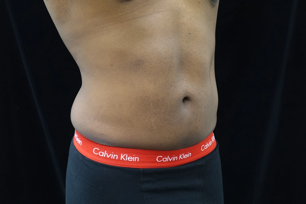 liposuction After Photo for Patient #5