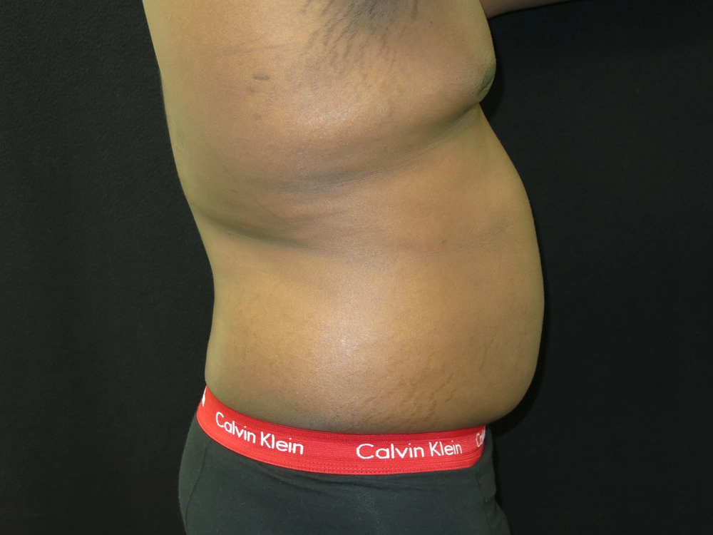 liposuction Before Photo for Patient #5