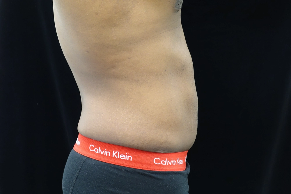 liposuction After Photo for Patient #5