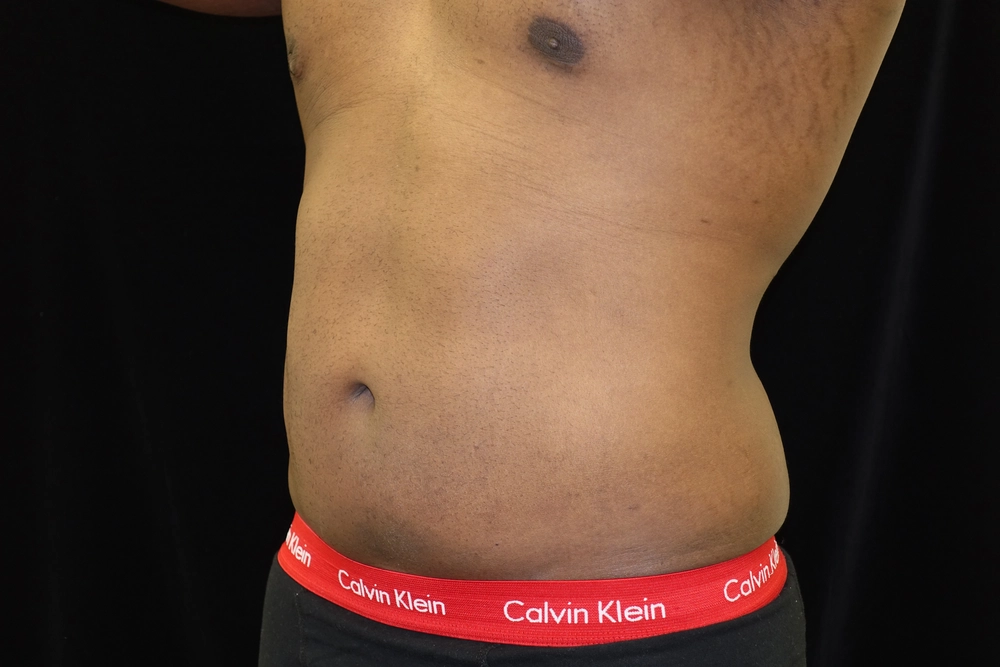 liposuction After Photo for Patient #5