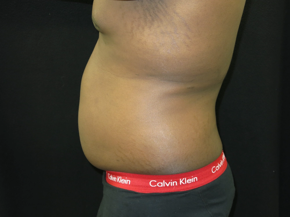 liposuction Before Photo for Patient #5