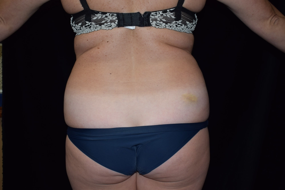 liposuction Before Photo for Patient #7