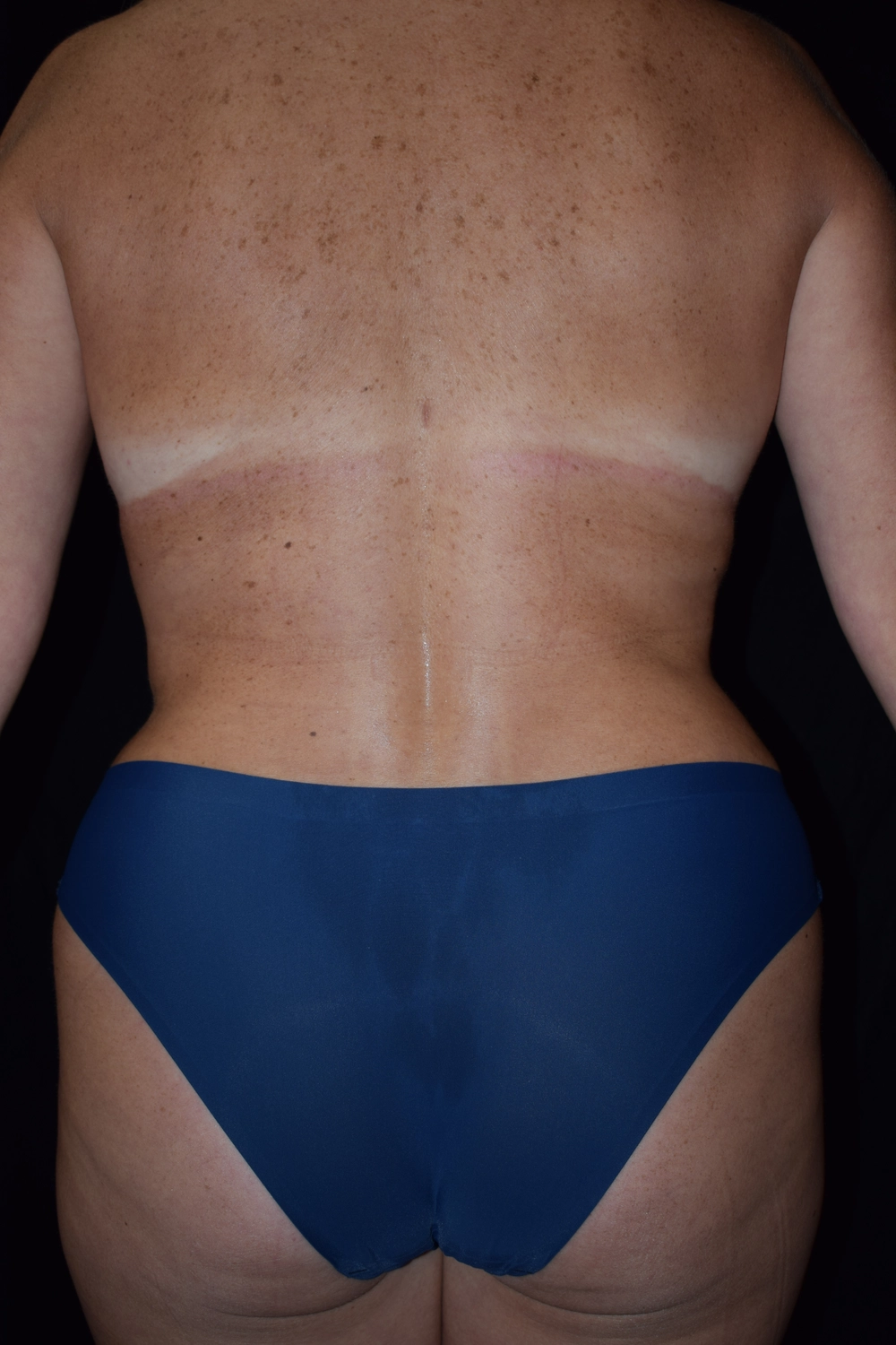 liposuction After Photo for Patient #7