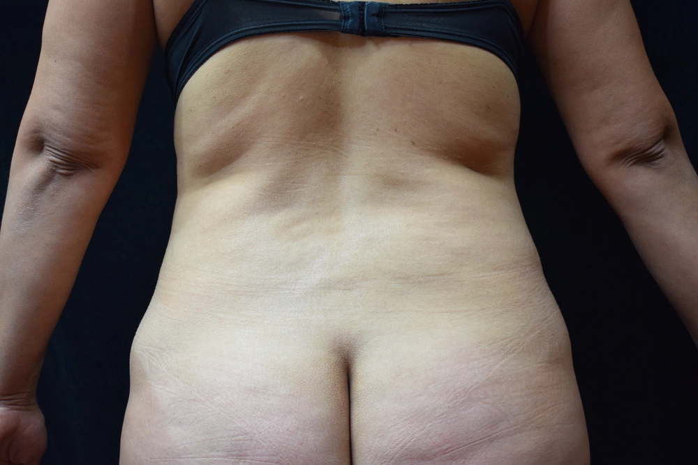 liposuction Before Photo for Patient #8