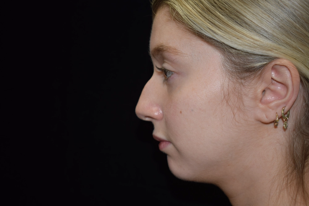 rhinoplasty Before Photo for Patient #1