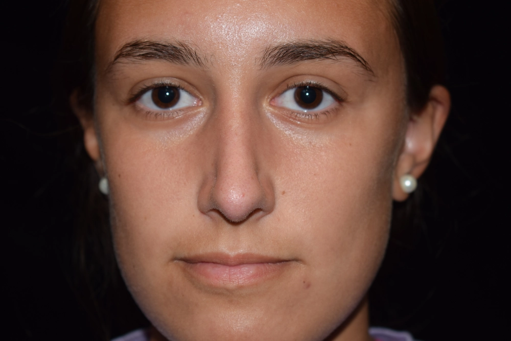 rhinoplasty After Photo for Patient #2