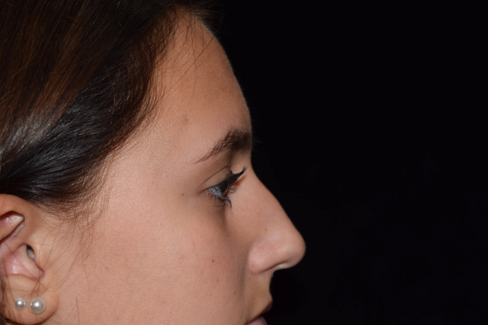rhinoplasty Before Photo for Patient #2