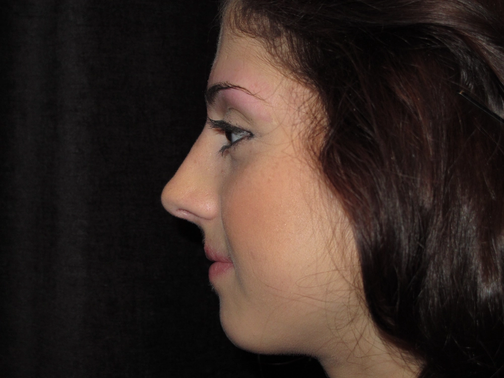 rhinoplasty After Photo for Patient #4
