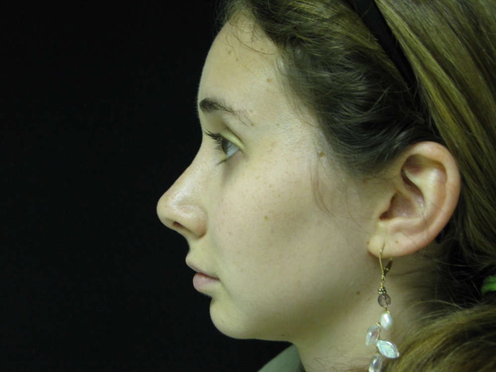 rhinoplasty After Photo for Patient #5