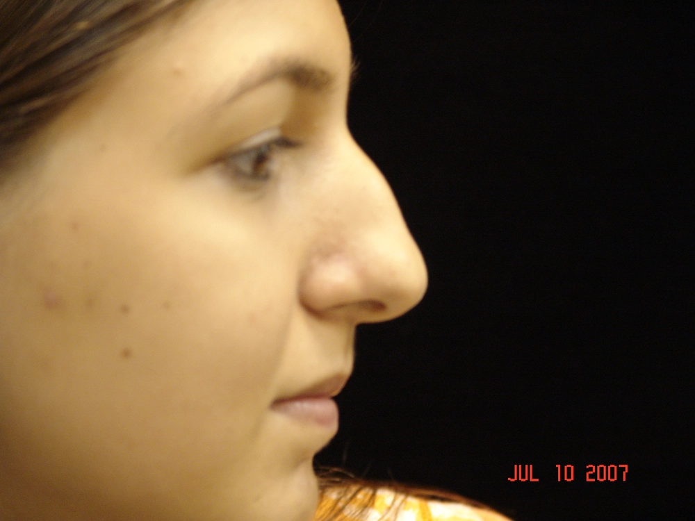 rhinoplasty Before Photo for Patient #6