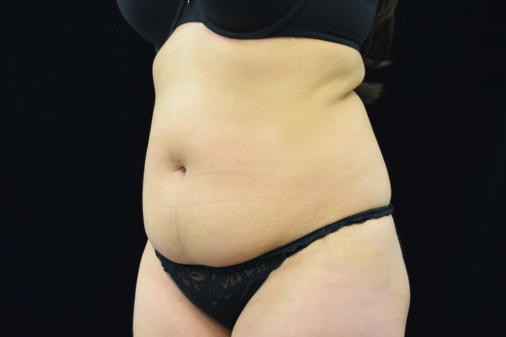 tummy-tuck Before Photo for Patient #9
