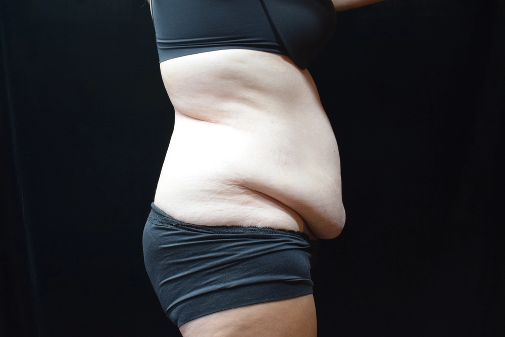 tummy-tuck After Photo for Patient #12