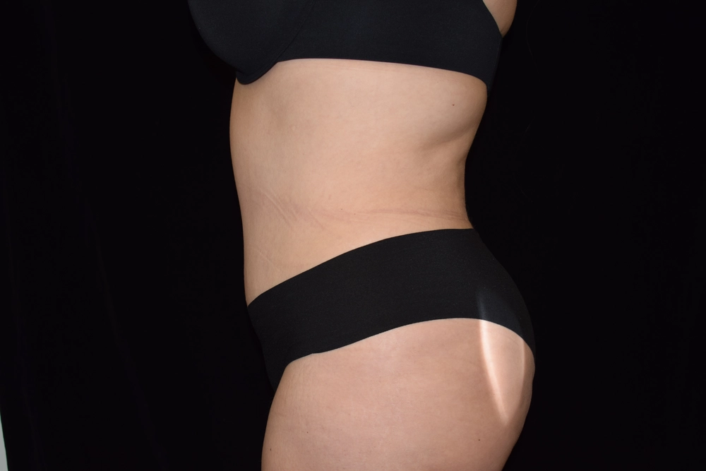 tummy-tuck Before Photo for Patient #15