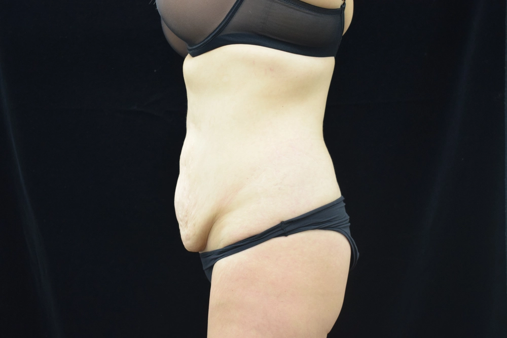 tummy-tuck Before Photo for Patient #20