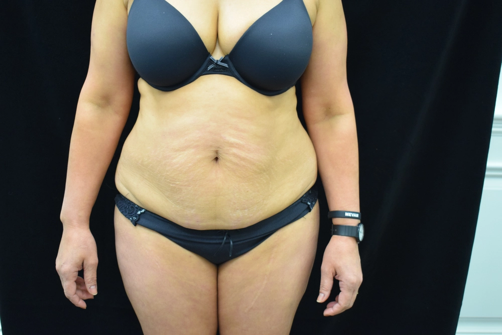 tummy-tuck Before Photo for Patient #2