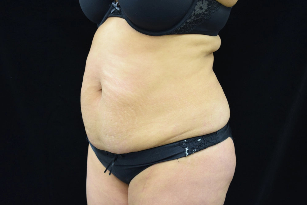 tummy-tuck Before Photo for Patient #2