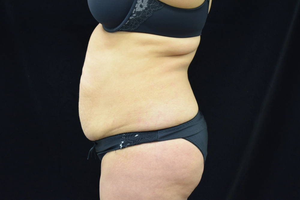 tummy-tuck Before Photo for Patient #2