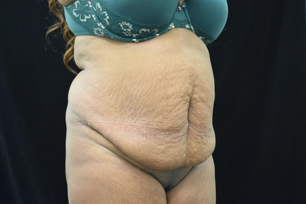 tummy-tuck Before Photo for Patient #28