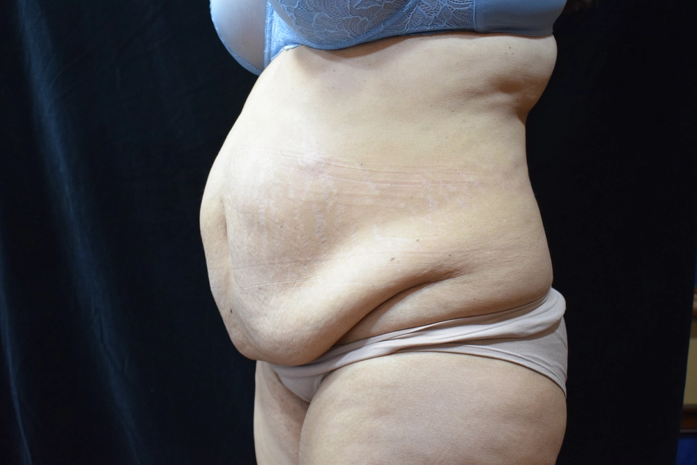tummy-tuck Before Photo for Patient #3